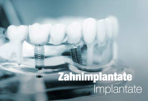 da-schau-her.de unsere Empfehlungen zum Thema ... Zahnimplantat Zahnimplantate in Offenburg 